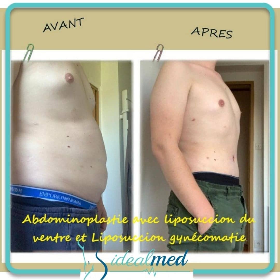 résultat abdominoplastie en Tunisie avant et après