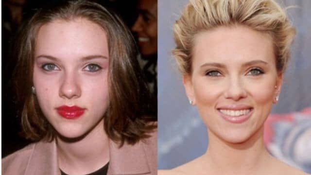 Rhinoplastie star