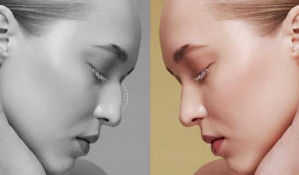 Rhinoplastie et Santé Mentale : Bienfaits Psychologiques