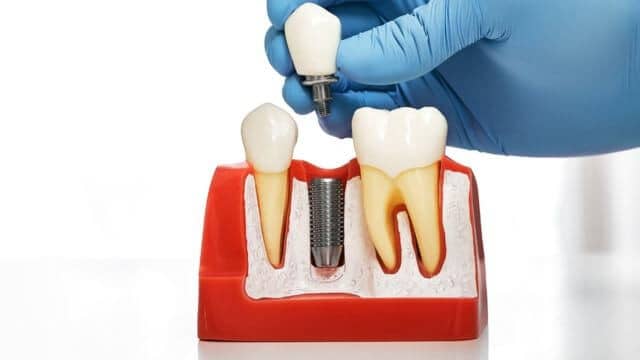 Pose implant dentaire Tunisie dès 600€ tout compris | Idealmed