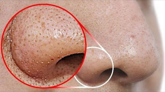Top 3 méthodes pour enlever point noir du nez sans abimer la peau