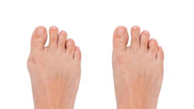 Corrigez votre pied trop moche grâce à la chirurgie esthetique