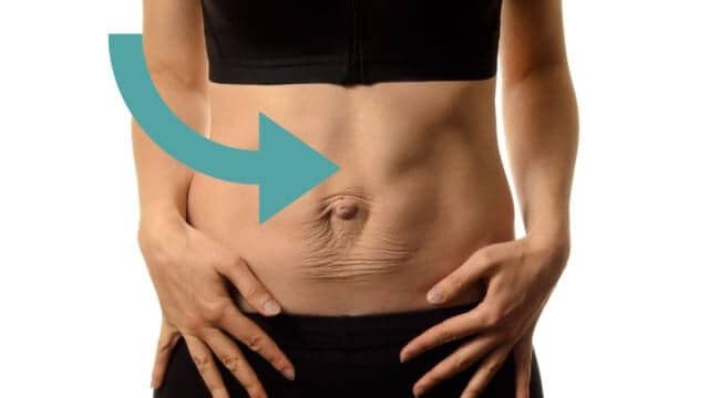 Découvrez les chirurgies pour corriger un diastasis grands droits