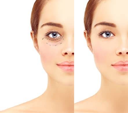 Blépharoplastie : que faut-il savoir sur cette chirurgie ?