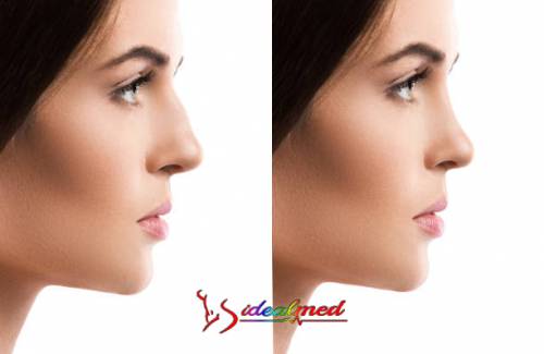 Rhinoplastie Tunisie : Refaire son nez à prix abordable