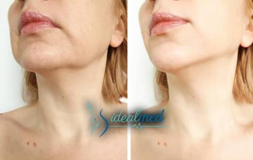 Guide complet sur la genioplastie Tunisie | Idealmed